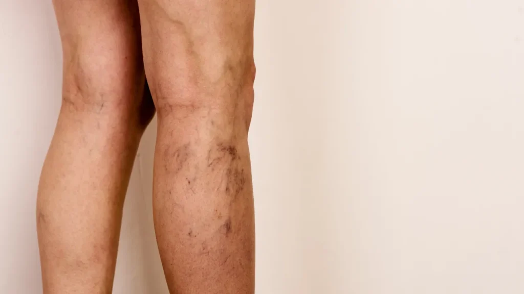 Quem Tem Varizes Pode Fazer Musculação? Quem Tem Varizes Pode Fazer Musculação?
